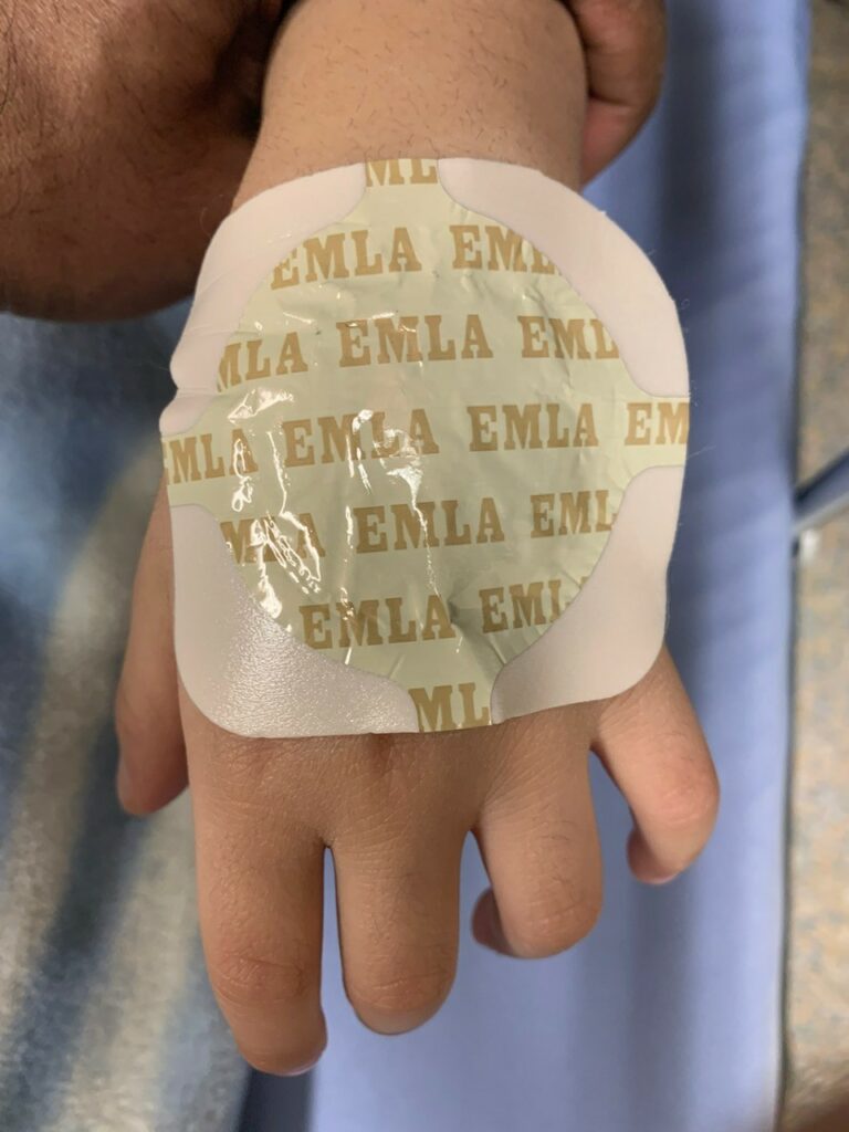 EMLA application, IV placement in the operating room and gauze hand wrap for IV security.