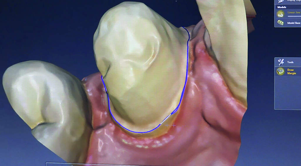 . Marking the preparation margin for designing a crown in inLab. 