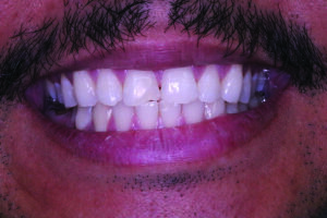 Extraoral view of the initial situation, the center line is correct.