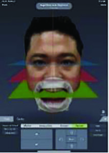  Result of the analysis from 3D facial scan on iPad pro. 