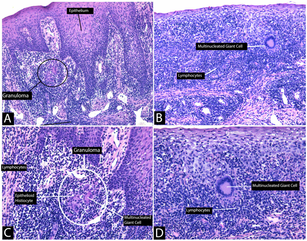 Histological view-staining with Hematoxylin & Eosin A). Low magnification of the lesion OFG shows hyperplastic, parakeratinized stratified squamous epithelium covering fibrous connective tissue. The connective tissue contains patchy dense chronic inflammatory infiltrates comprised of lymphocytes and plasma cells as well as scattered non-necrotizing/non-caseating granulomas consisting of epithelioid histiocytes and multinucleated giant cells. B) Lower magnification of OFG shows presence of dense inflammatory lymphocytic infiltration and a multinucleated giant cell. (H&E; original magnification Å~10). C) Higher magnification of OFG non-caseating granuloma showing multinucleated giant cell, epithelioid histiocyte and infiltration of lymphocytes. D) Higher magnification of OFG Showing enlarged view of the multinucleated giant cell and infiltration of lymphocytes and plasma cells extending into the epithelium. (H&E; original magnification Å~200).