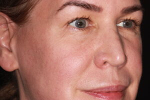 Patient A: 2021 lack of crow’s feet around the eyes