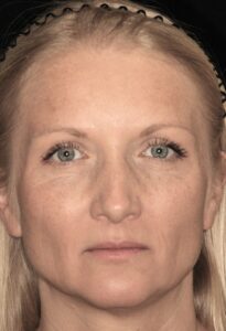  Patient B: 2022 after 10 years of regular treatment. Note lack of forehead lines, frown lines and crow’s feet despite the passage of 10 years. 