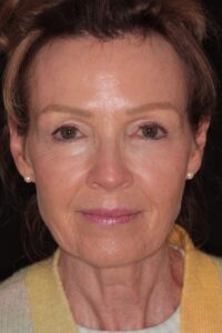 Patient C: 2 weeks after treatment all the lines are significantly diminished. 