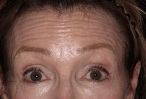 Patient C: Before treatment activation of the frontals muscle in the forehead produces marked horizontal lines.  
