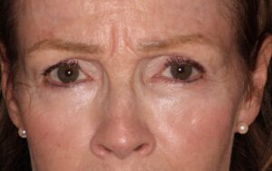  Patient C: Before treatment activation of the glabella (area between the eyebrows) produces strong frown lines.  