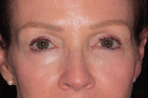 Patient C: 2 weeks after treatment similar activation of the glabella no longer produces frown lines. The skin is smooth.
