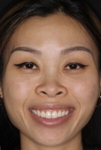  Patient D: Before treatment of a gummy smile in a young female by injecting LLSANS near its origin. 