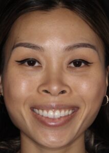 Patient D: 2 weeks after treatment of the gummy smile showing relaxation of the upper lip.  