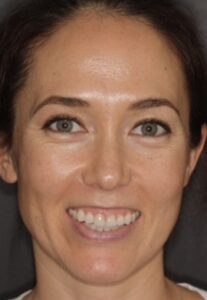 Patient E: Before treatment of a more severe gummy smile that required injection into both upper and lower areas of LLSANS. 