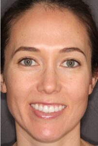  Patient E: After treatment showing relaxation of the upper lip following iniection into both upper and lower LLSANS. 