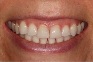  Patient E: Before treatment of the more severe gummy smile.  