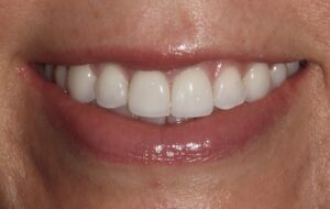 Patient E: After treatment of the more severe gummy smile following iniection into both upper and lower LLSANS.