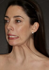 Patient G: Activation of platysma muscle in a young female showing the strong bands that are responsible for development of necklace lines and jowls. 