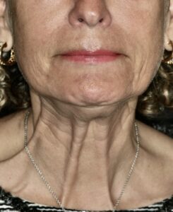 Patient H: Before treatment of platysma in a more mature female showing the strong platysma bands during activation and the necklace lines created.  