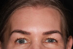 Patient A: 2021 note lack of forehead lines after 13 years of regular treatment.  