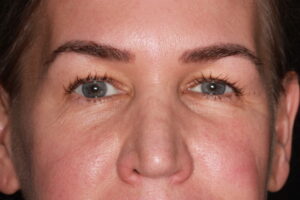 Patient A: 2021 no frown lines between the eyebrows despite the passage of time.