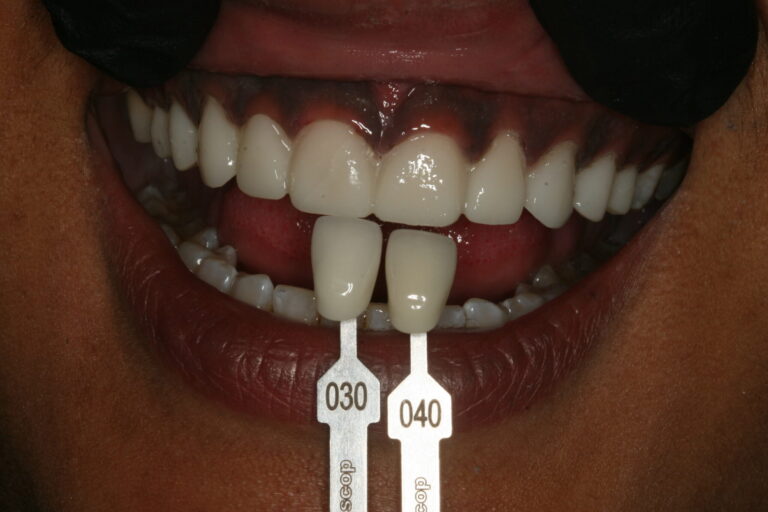 . Planned tooth shade.