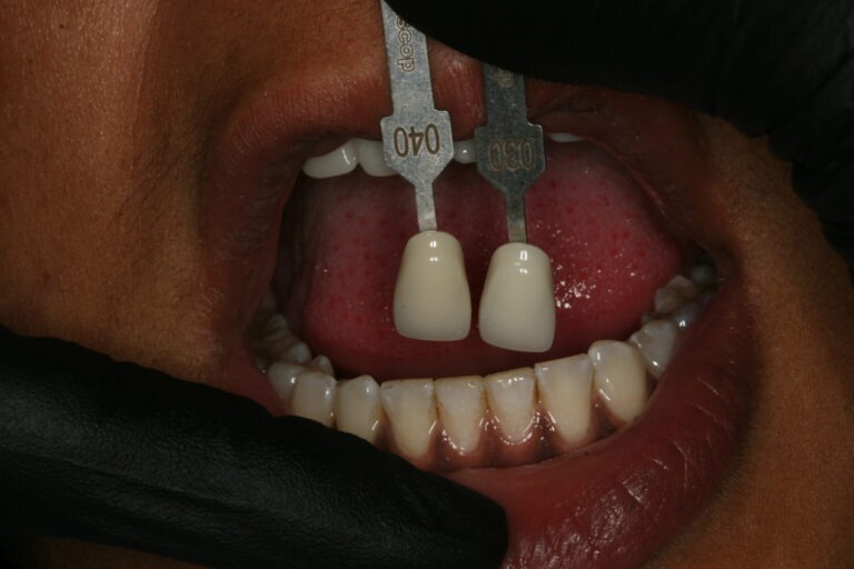 Shade comparison with opposing dentition.