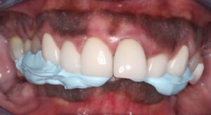Frontal view of centric relation bite registration using.  
