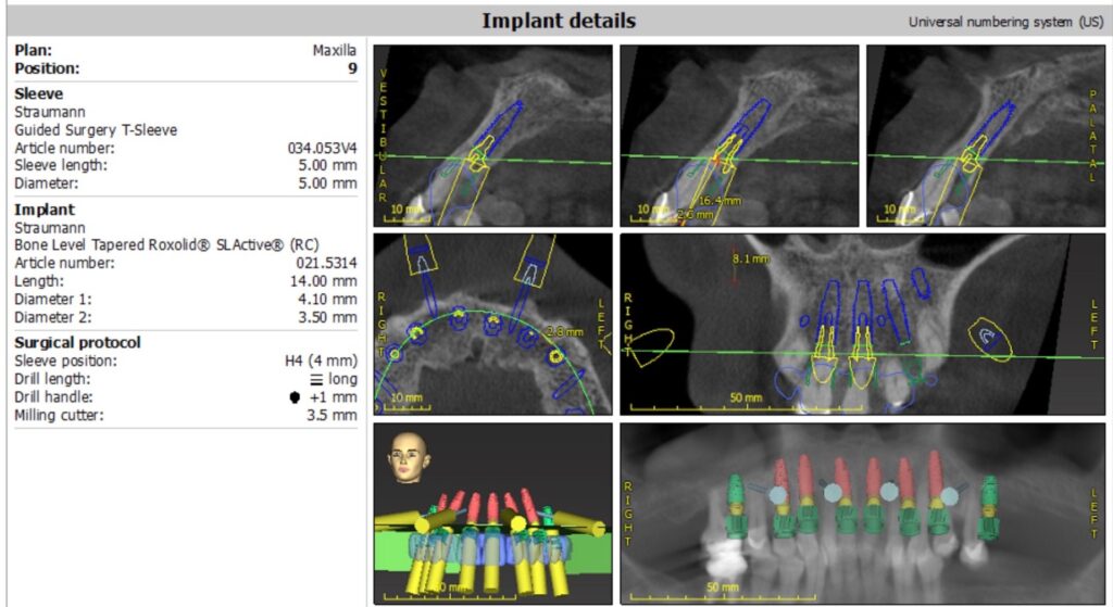 . Maxillary surgical treatment planning using coDiagnostix (Dental Wings software).  