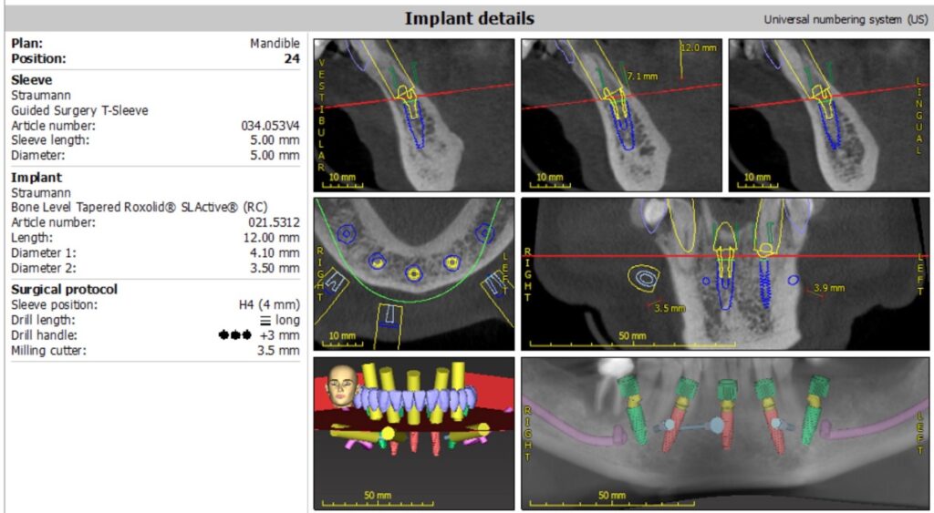 Mandibular surgical treatment planning using coDiagnostix (Dental Wings software).  