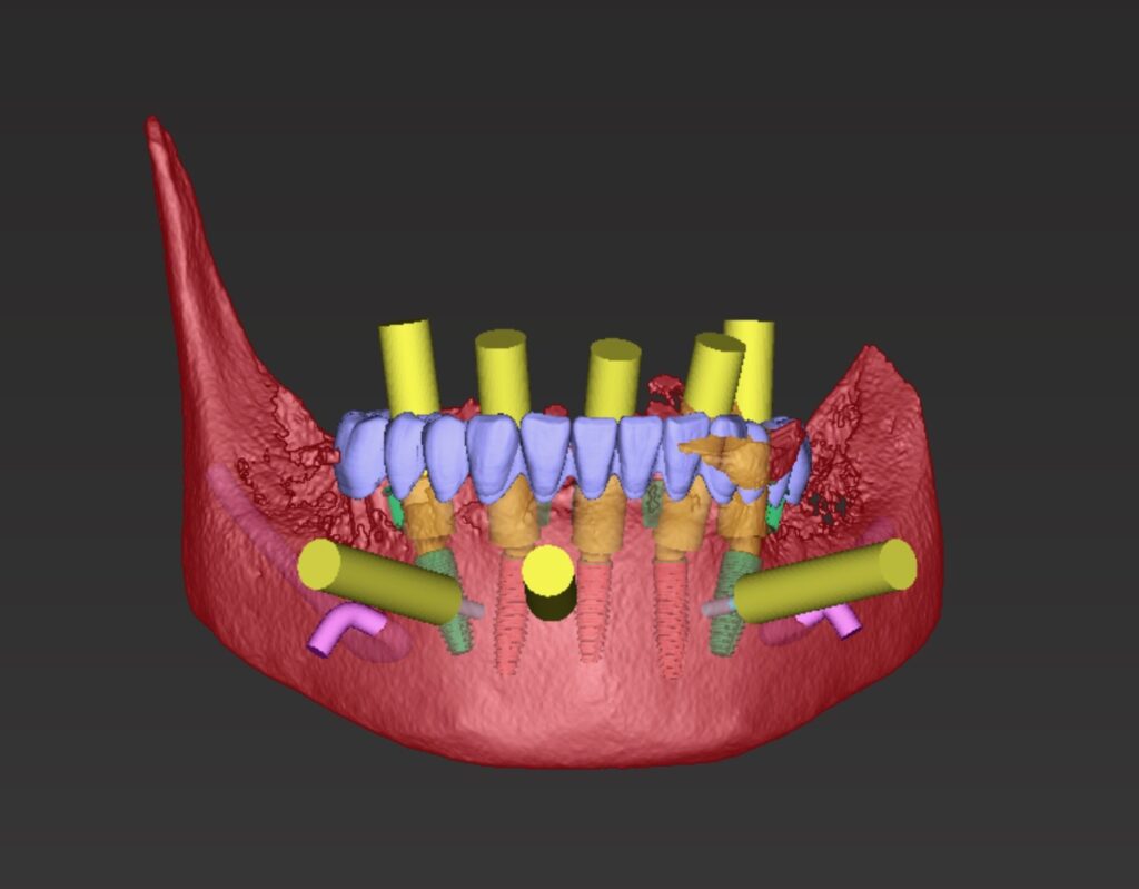 Mandibular surgical treatment planning with mandibular prosthesis using coDiagnostix (Dental Wings software).
