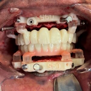  Maxillary and mandibular unilateral key fixation foundation guides made from Flexcera (Desktop Health) with indexed transitional Flexcera Smile (Desktop Health) prostheses prior to pick up.  