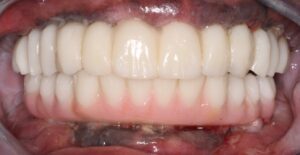 Full maxillary and mandibular PMMA transitional prostheses, 1 day after surgery.