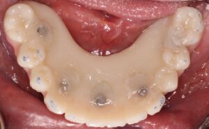 . Occlusal view of mandibular PMMA Flexcera Smile (Desktop Health) prosthesis.
