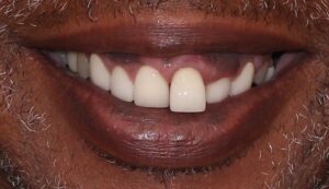 Frontal view of patient’s smile