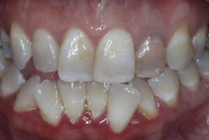  The left maxillary later incisor has experienced internal staining following endodontic treatment. 