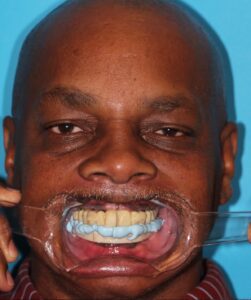 Full face retracted view of centric relation bite registration using Blu-Mousse vinyl polysiloxane (VPS) Bite Registration (Parkell) for the final impression using the transitional acrylic duplicate.