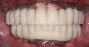 Frontal view of try-in PMMA final prostheses duplicates to assess function and aesthetics.