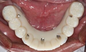 Occlusal view of full mandibular arch try-in PMMA duplicate of final prosthesis.