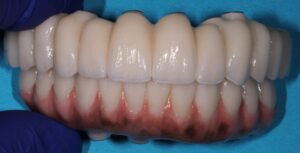 Full zirconia solid zirconia Argen High Translucency Plus Mulitlayer 4Yitrium final prostheses with characterized gingiva. 