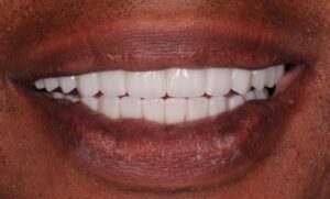 Frontal view of patient’s smile with improved aesthetics and function.  