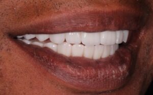 Right lateral view of patient’s smile.  