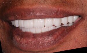  Left lateral view of patient’s smile.