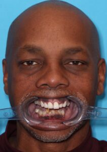 Full face retracted view of patient demonstrating functional and aesthetic challenges.  