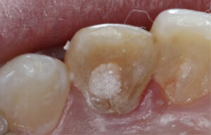 The endodontic access opening was exposed and filled with sodium perborate and then covered with a provisional material in order to perform the internal bleaching technique.  