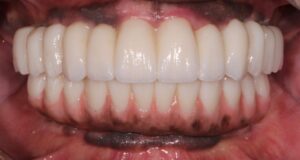  Frontal view of patients improved vertical dimension, function and aesthetics.  