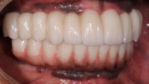  Right lateral view of patient in maximum intercuspation.  