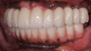  Left lateral view of patient in maximum intercuspation.  