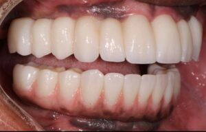 Right lateral view of completed case.  
