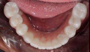 Mandibular occlusal view of completed case.