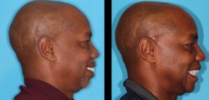 Before and after profile view showing improved lower facial third proportion and autorotation of the mandible.