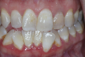  A moderate improvement in appearance was seen on the left maxillary lateral incisor following 3 weeks of internal bleaching (new sodium perborate every week)
