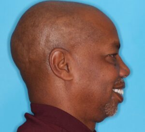  Right lateral profile view.  