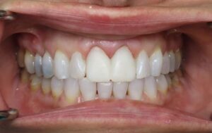 Provisional restorations cemented on maxillary central incisors.  